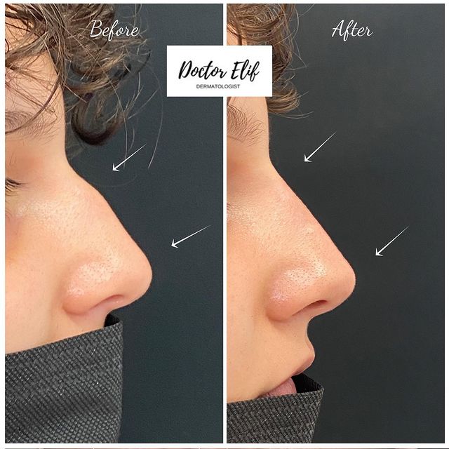 Nose filler