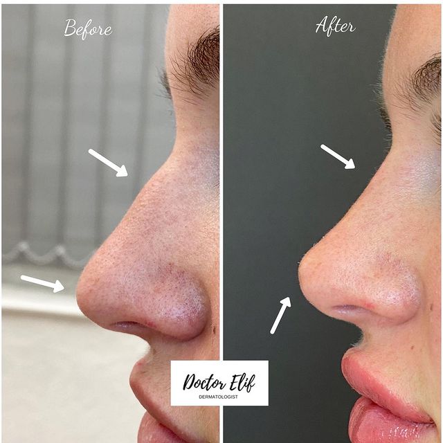Nose filler