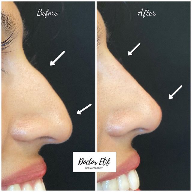 Nose filler