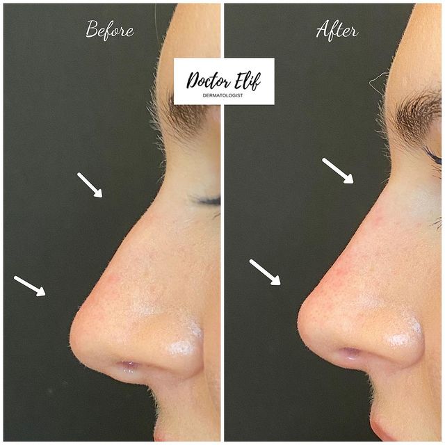 Nose filler