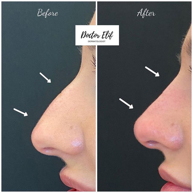 non surgical nose job