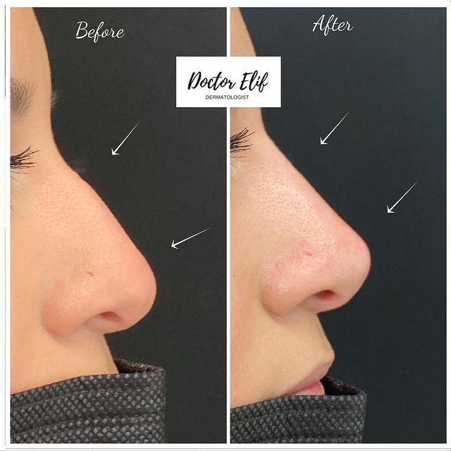 non surgical nose job