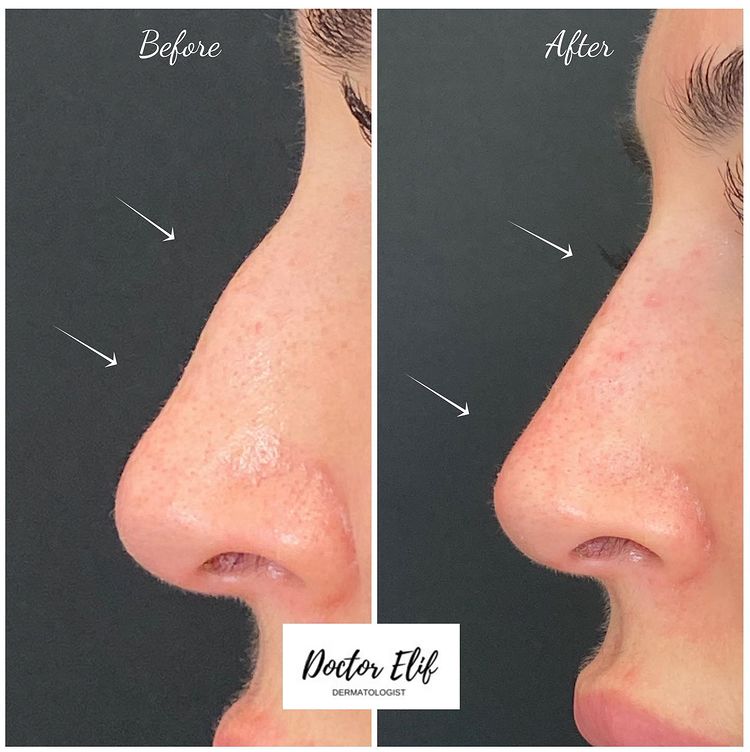 non surgical nose job