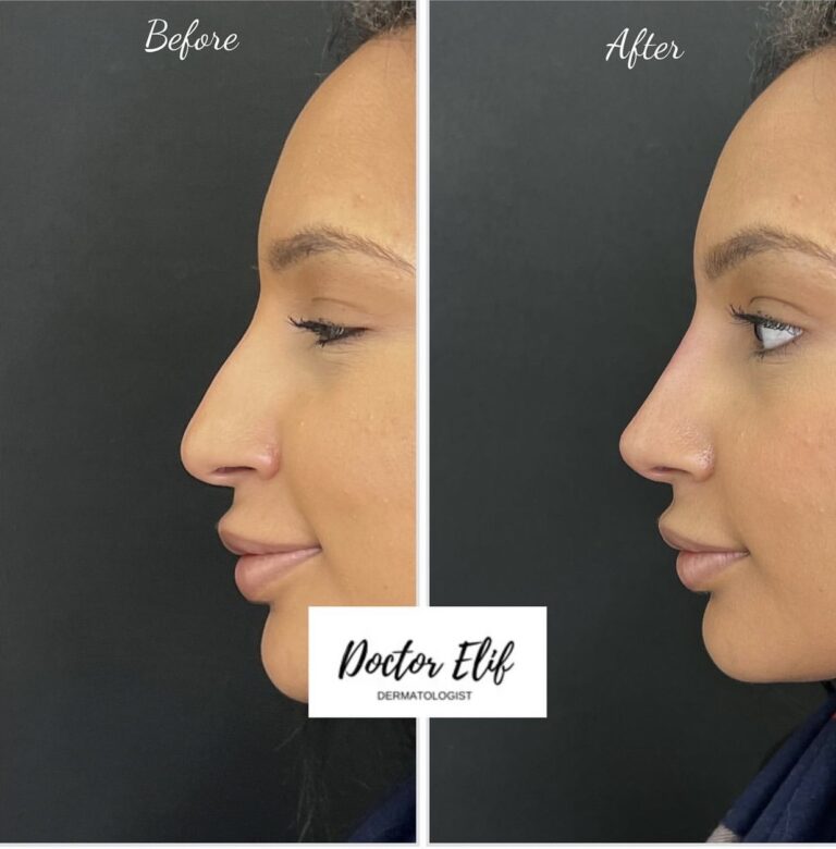 non surgical nose job
