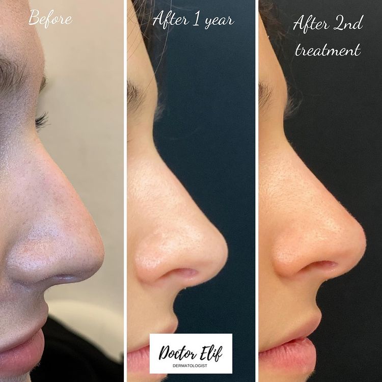 non surgical nose job