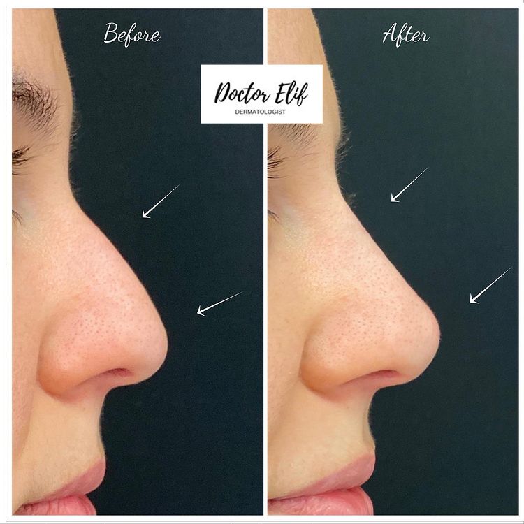 non surgical nose job