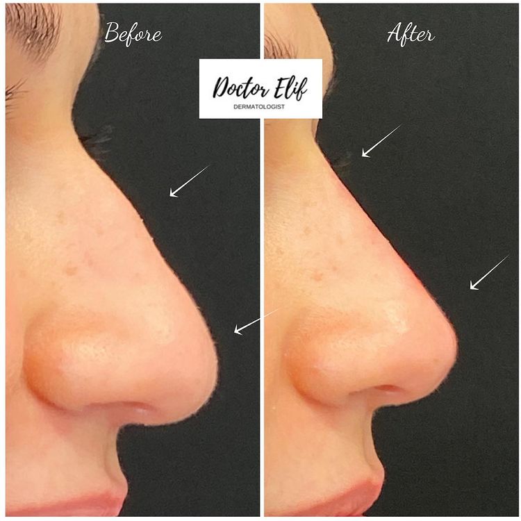 non surgical nose job