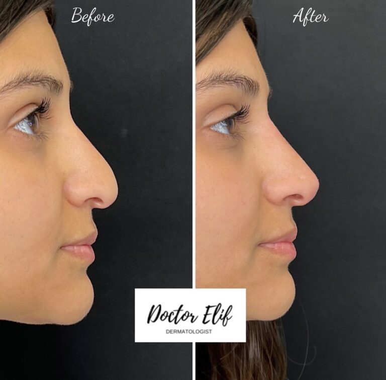 non surgical nose job