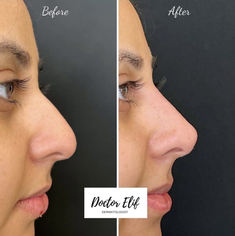 non surgical nose job