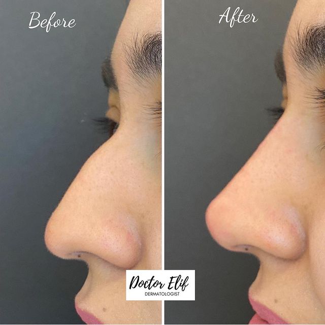 non surgical nose job