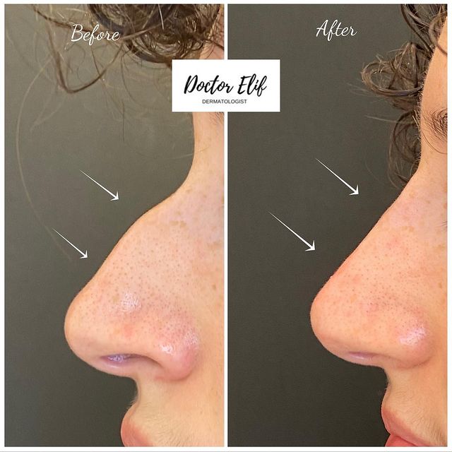 non surgical nose job