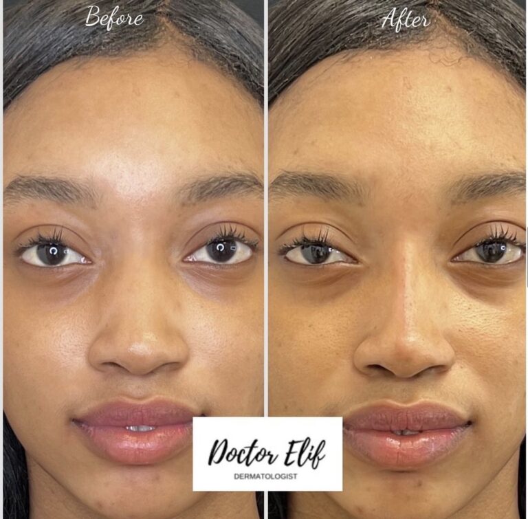 non surgical nose job